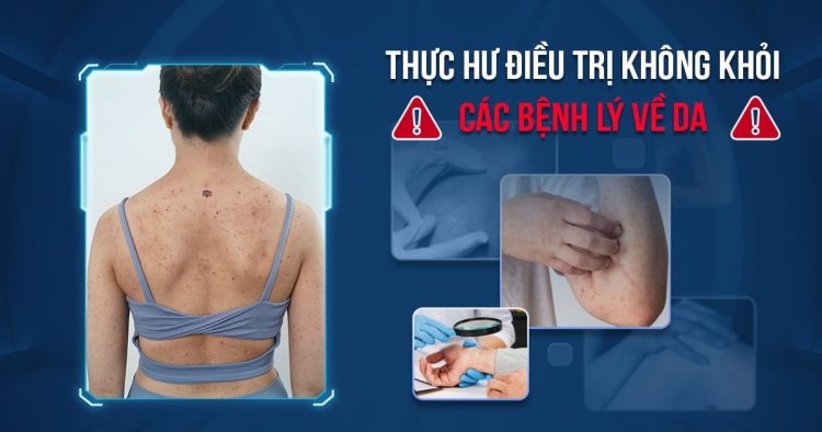 THỰC HƯ VỀ ĐIỀU TRỊ “KHÔNG KHỎI” CÁC BỆNH LÝ VỀ DA